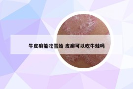 牛皮癬能吃雪蛤 皮癬可以吃牛蛙嗎