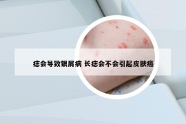 痣會(huì)導(dǎo)致銀屑病 長(zhǎng)痣會(huì)不會(huì)引起皮膚癌