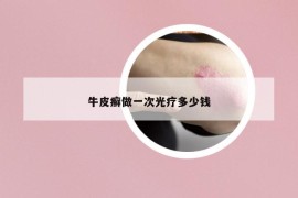 牛皮癬做一次光療多少錢