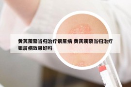 黃芪蒺藜當歸治療銀屑病 黃芪蒺藜當歸治療銀屑病效果好嗎
