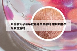 銀屑病懷孕會(huì)導(dǎo)致胎兒白血病嗎 銀屑病懷孕后會(huì)加重嗎