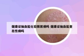 健康證抽血能化驗(yàn)銀屑病嗎 健康證抽血能查出性病嗎
