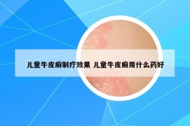兒童牛皮癬制療效果 兒童牛皮癬用什么藥好