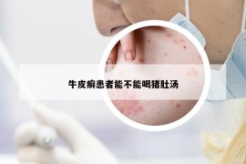 牛皮癬患者能不能喝豬肚湯