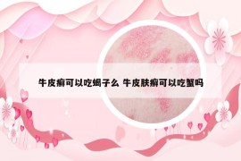 牛皮癬可以吃蝎子么 牛皮膚癬可以吃蟹嗎