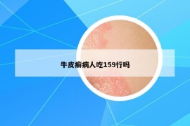 牛皮癬病人吃159行嗎