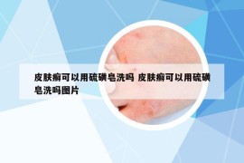 皮膚癬可以用硫磺皂洗嗎 皮膚癬可以用硫磺皂洗嗎圖片
