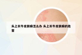 頭上長牛皮膚癬怎么辦 頭上長牛皮膚癬的危害