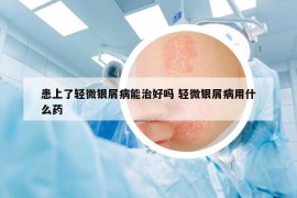患上了輕微銀屑病能治好嗎 輕微銀屑病用什么藥