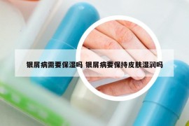 銀屑病需要保濕嗎 銀屑病要保持皮膚濕潤嗎