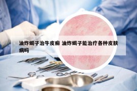 油炸蝎子治牛皮癬 油炸蝎子能治療各種皮膚病嗎
