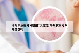 治療牛皮癬用5度醋什么意思 牛皮膚癬可以用醋洗嗎