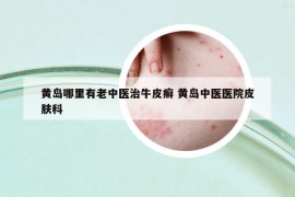 黃島哪里有老中醫(yī)治牛皮癬 黃島中醫(yī)醫(yī)院皮膚科