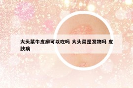 大頭菜牛皮癬可以吃嗎 大頭菜是發(fā)物嗎 皮膚病