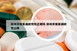 鄭州市銀屑病研究所正規(guī)嗎 鄭州市銀屑病研究口碑