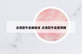 點(diǎn)滴型牛皮癬蛻皮 點(diǎn)滴型牛皮屑初期