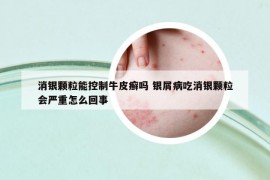 消銀顆粒能控制牛皮癬嗎 銀屑病吃消銀顆粒會嚴重怎么回事