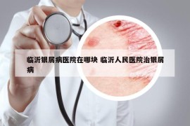 臨沂銀屑病醫(yī)院在哪塊 臨沂人民醫(yī)院治銀屑病