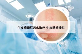 牛皮癬潰爛怎么治療 牛皮膚癬潰爛