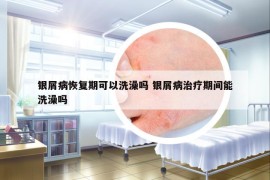 銀屑病恢復期可以洗澡嗎 銀屑病治療期間能洗澡嗎