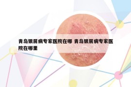 青島銀屑病專家醫(yī)院在哪 青島銀屑病專家醫(yī)院在哪里