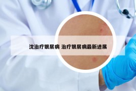 沈治療銀屑病 治療銀屑病最新進(jìn)展