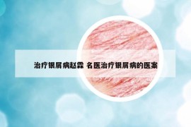 治療銀屑病趙霖 名醫(yī)治療銀屑病的醫(yī)案
