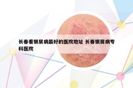 長春看銀屑病最好的醫(yī)院地址 長春銀屑病?？漆t(yī)院