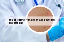 臍帶血干細(xì)胞治療銀屑病 臍帶血干細(xì)胞治療銀屑病有用嗎