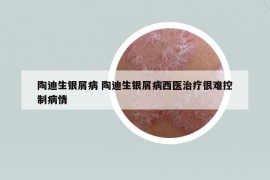 陶迪生銀屑病 陶迪生銀屑病西醫(yī)治療很難控制病情