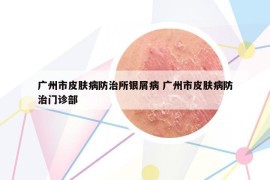 廣州市皮膚病防治所銀屑病 廣州市皮膚病防治門診部