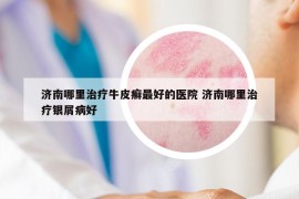 濟(jì)南哪里治療牛皮癬最好的醫(yī)院 濟(jì)南哪里治療銀屑病好