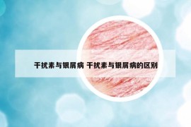干擾素與銀屑病 干擾素與銀屑病的區(qū)別