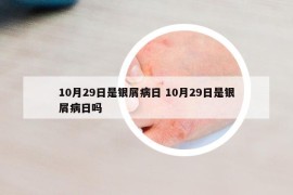 10月29日是銀屑病日 10月29日是銀屑病日嗎
