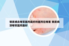 銀屑病去哪家醫(yī)院最好的醫(yī)院在哪里 銀屑病到哪家醫(yī)院最好