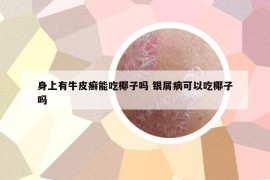 身上有牛皮癬能吃椰子嗎 銀屑病可以吃椰子嗎