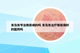 青島有專治銀屑病的嗎 青島有治療銀屑病好的醫(yī)院嗎