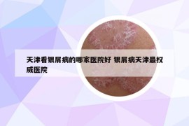 天津看銀屑病的哪家醫(yī)院好 銀屑病天津最權(quán)威醫(yī)院