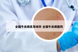 全國牛皮癬高發(fā)城市 全國牛皮癬醫(yī)院