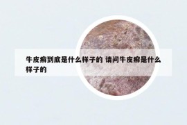 牛皮癬到底是什么樣子的 請問牛皮癬是什么樣子的