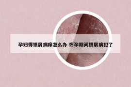 孕婦得銀屑病癢怎么辦 懷孕期間銀屑病犯了