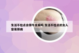 生活不檢點(diǎn)會得牛皮癬嗎 生活不檢點(diǎn)的女人容易得病