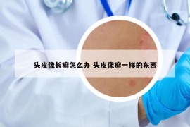 頭皮像長癬怎么辦 頭皮像癬一樣的東西