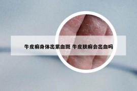 牛皮癬身體出紫血斑 牛皮膚癬會出血嗎