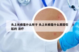 頭上長癬是什么樣子 頭上長癬是什么原因引起的 治療