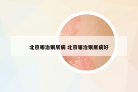 北京哪治銀屑病 北京哪治銀屑病好