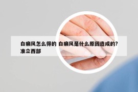 白癩風(fēng)怎么得的 白癩風(fēng)是什么原因造成的?準(zhǔn)立西部