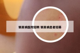 銀屑病醫(yī)院招聘 銀屑病患者招募