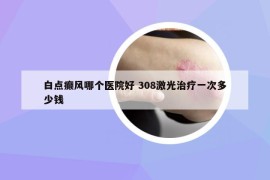 白點(diǎn)癲風(fēng)哪個(gè)醫(yī)院好 308激光治療一次多少錢