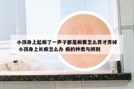 小孩身上起癬了一聲子都是癬要怎么弄才弄掉 小孩身上長癬怎么辦 癬的種類與辨別